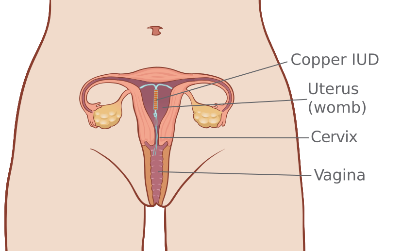 Copper_IUD_in_uter_S1