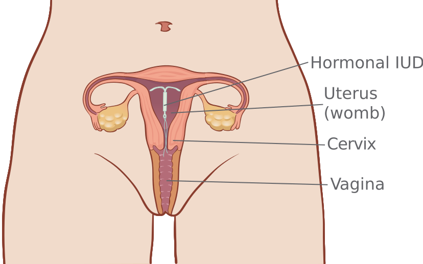 Hormonal_IUD_S1